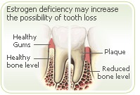 آثار مرض ترقق العظام  Osteoporosis على الفك والأسنان