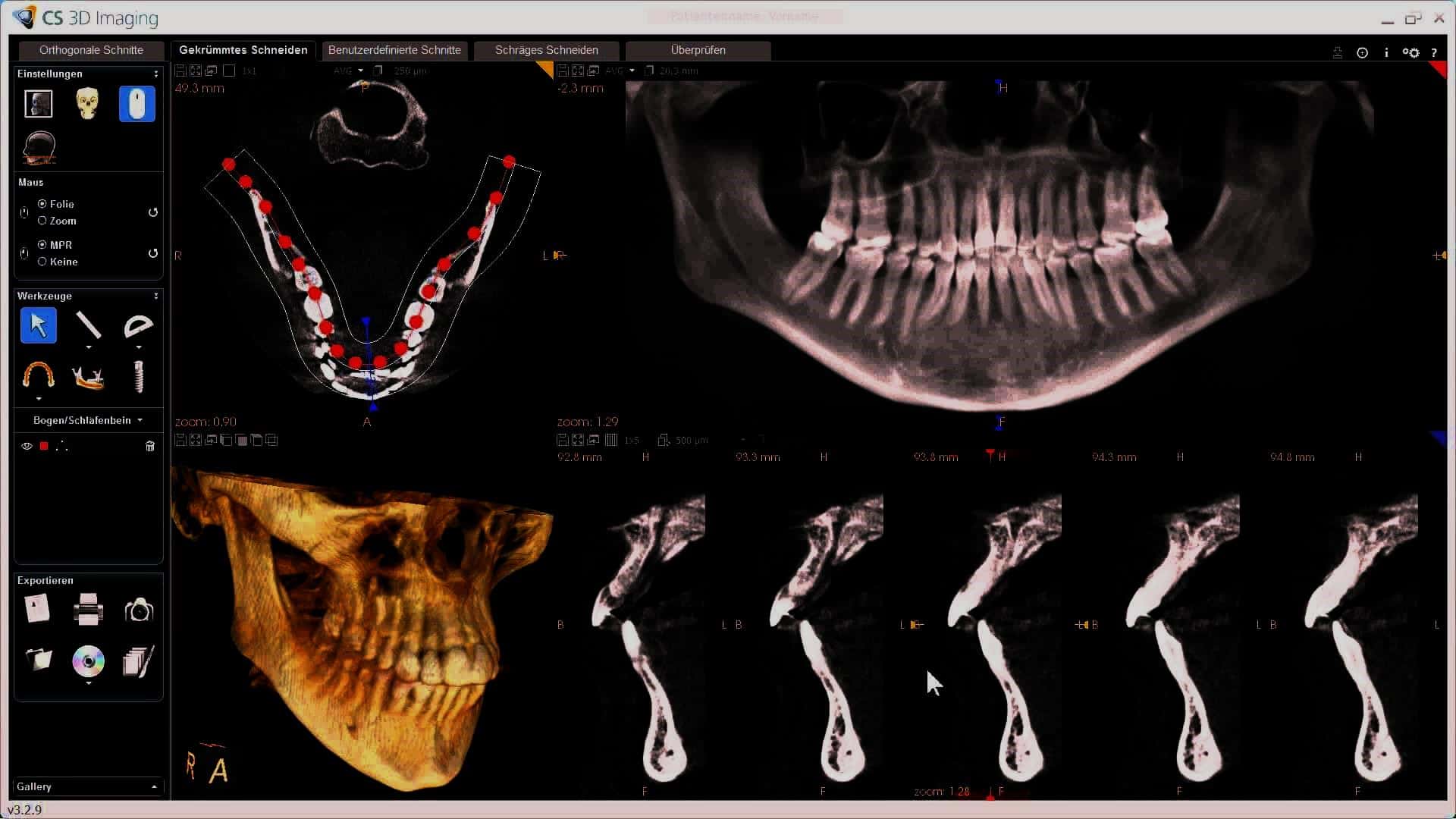 نوعية العظم السنخي Alveolar Bone Quality وأهميتها في علم زرع الأسنان
