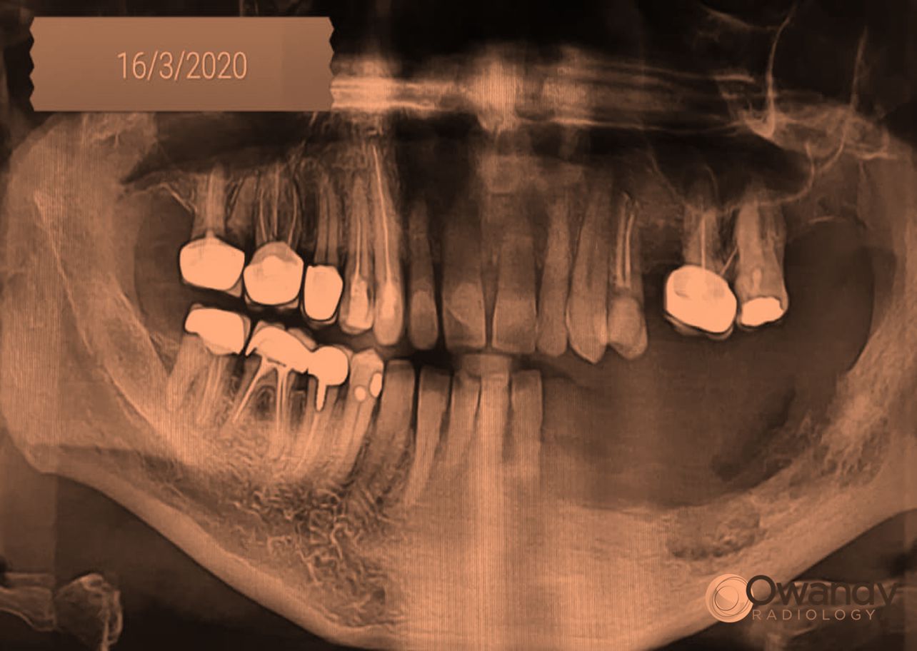 الأمواج فوق الصوتية في جراحة التهاب العظم والنقي في الفك السفلي Osteomyelitis
